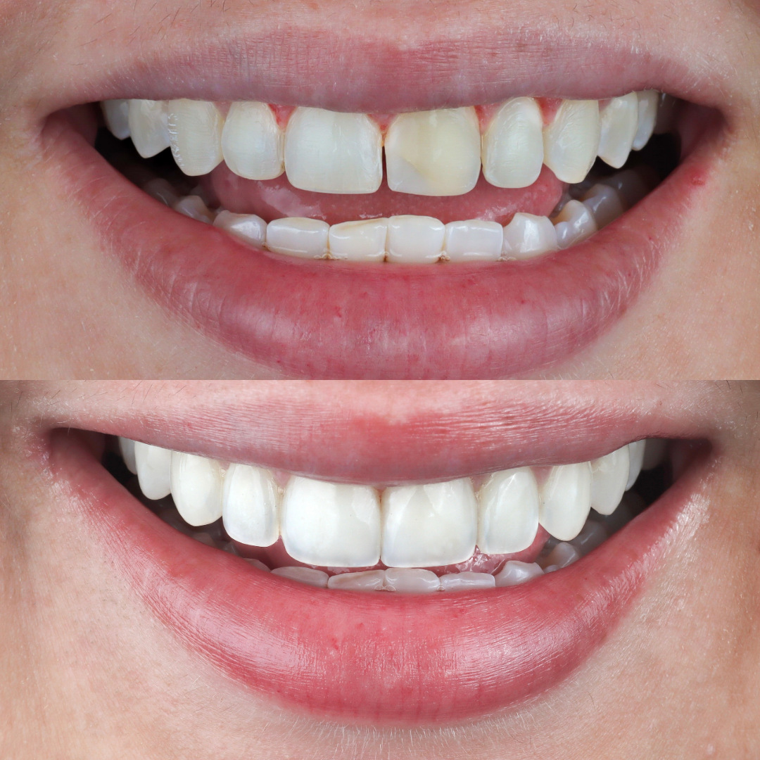 Caso real: antes y después de diseño de sonrisa