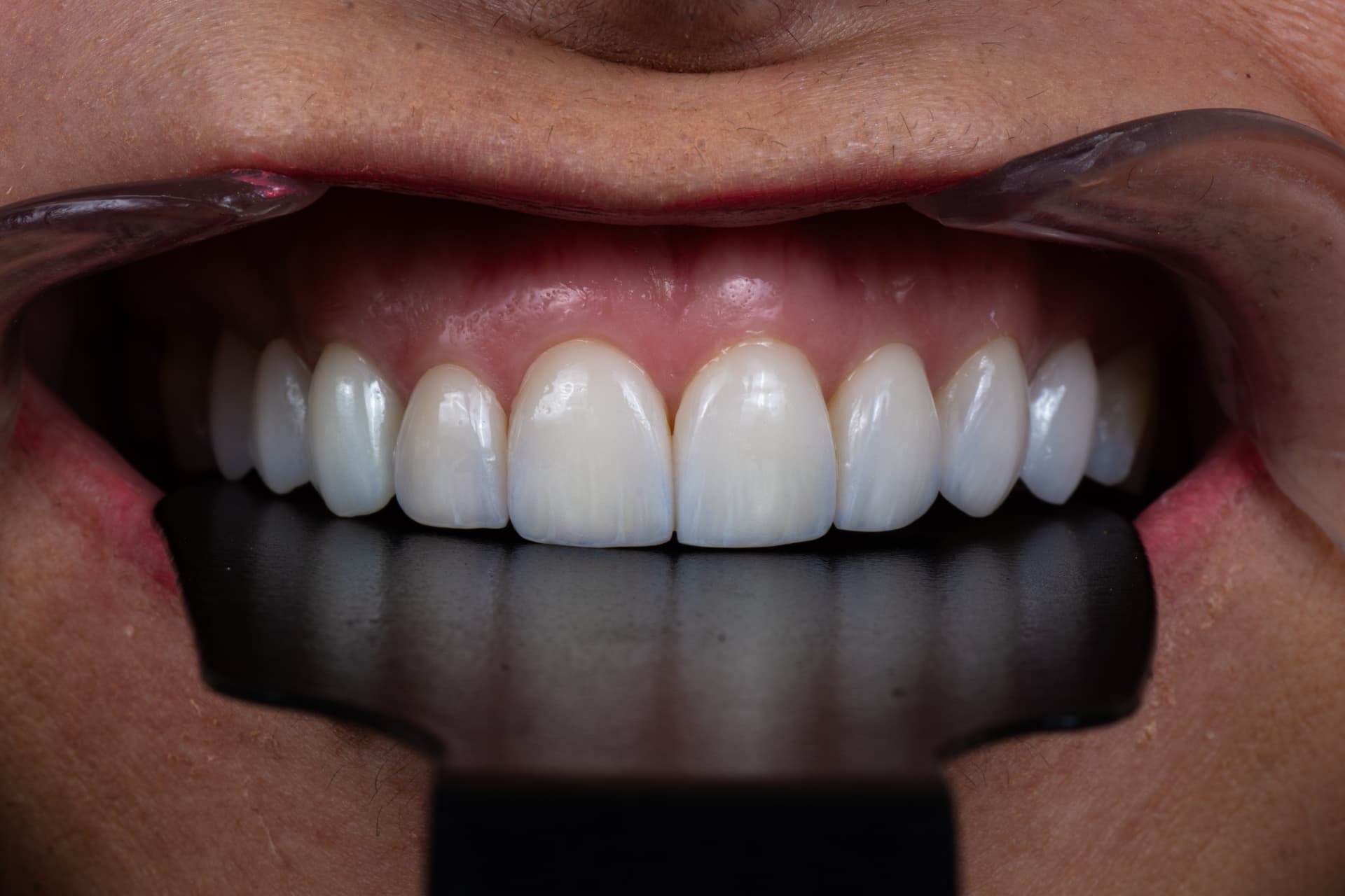 Diseño de sonrisa en resina estratificada — después