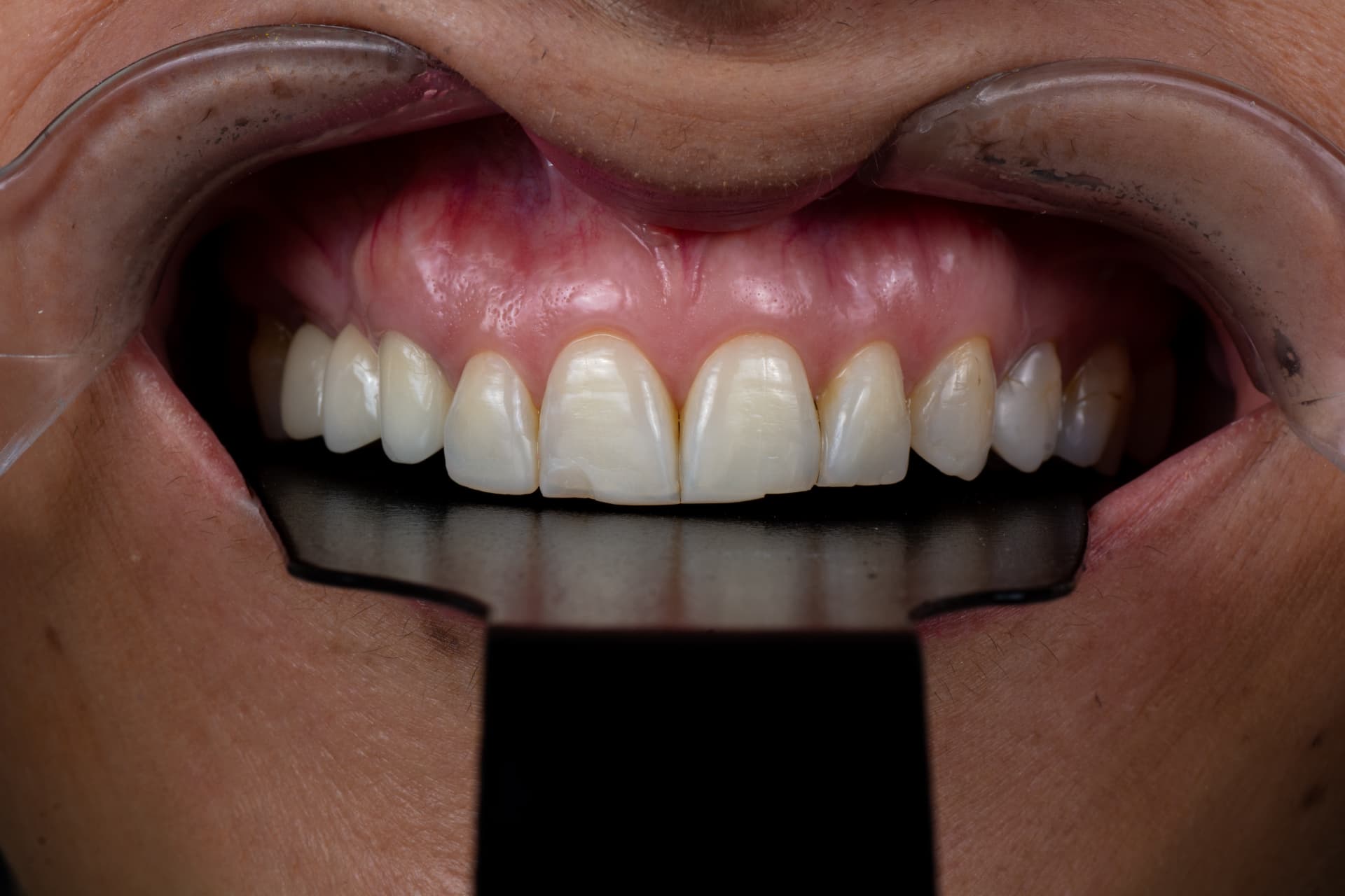 Diseño de sonrisa en resina estratificada — antes