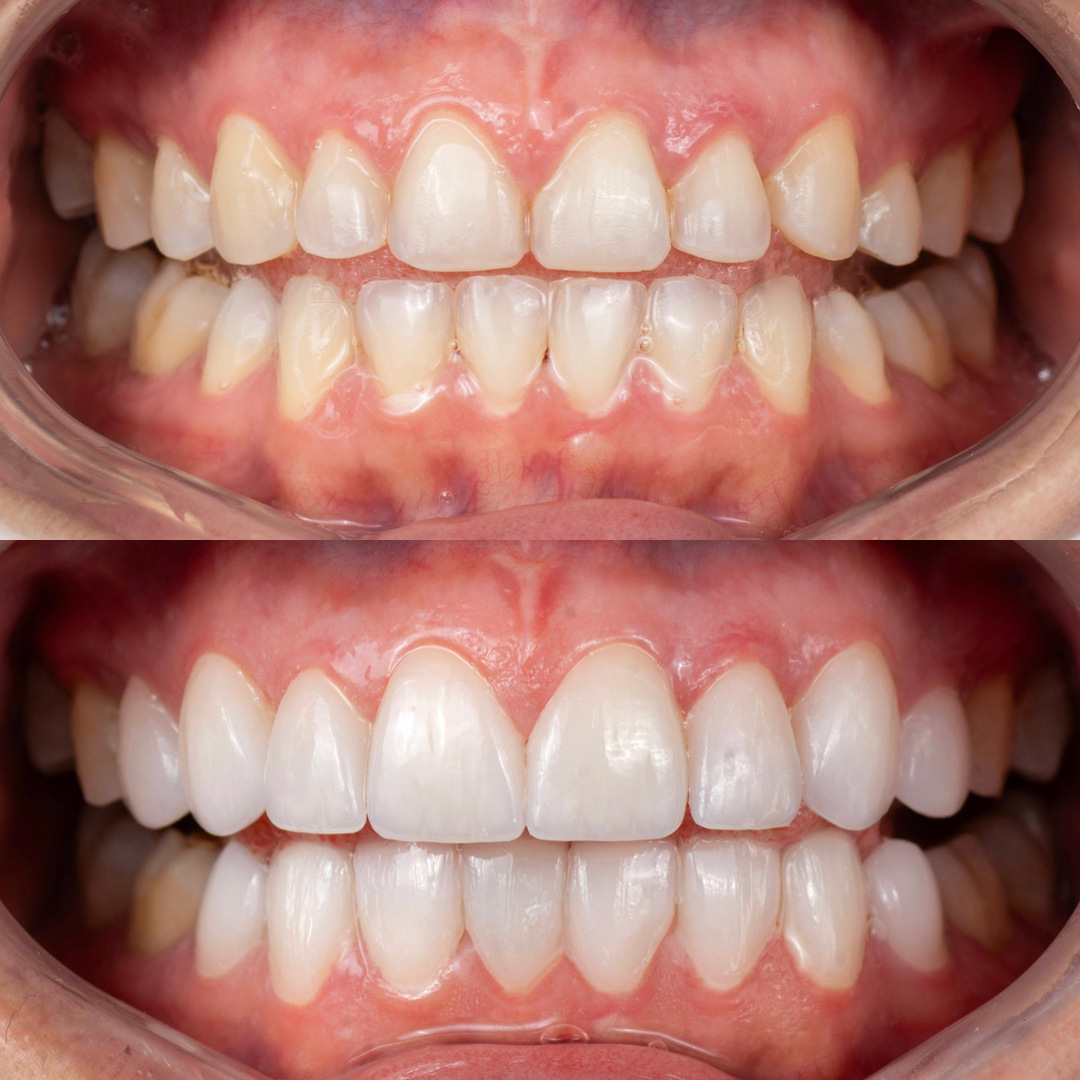 Caso real: antes y después de diseño de sonrisa