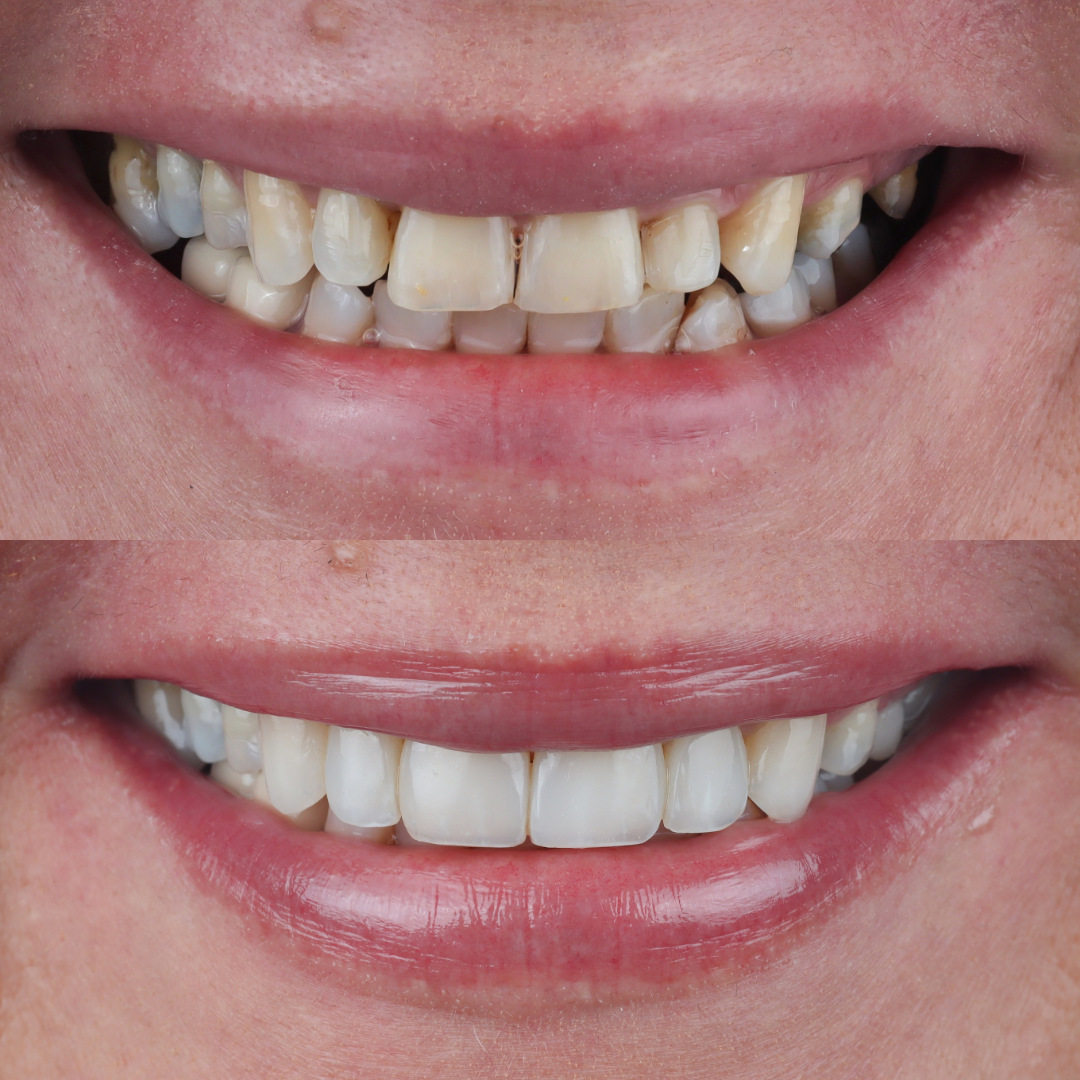 Caso real: antes y después de diseño de sonrisa
