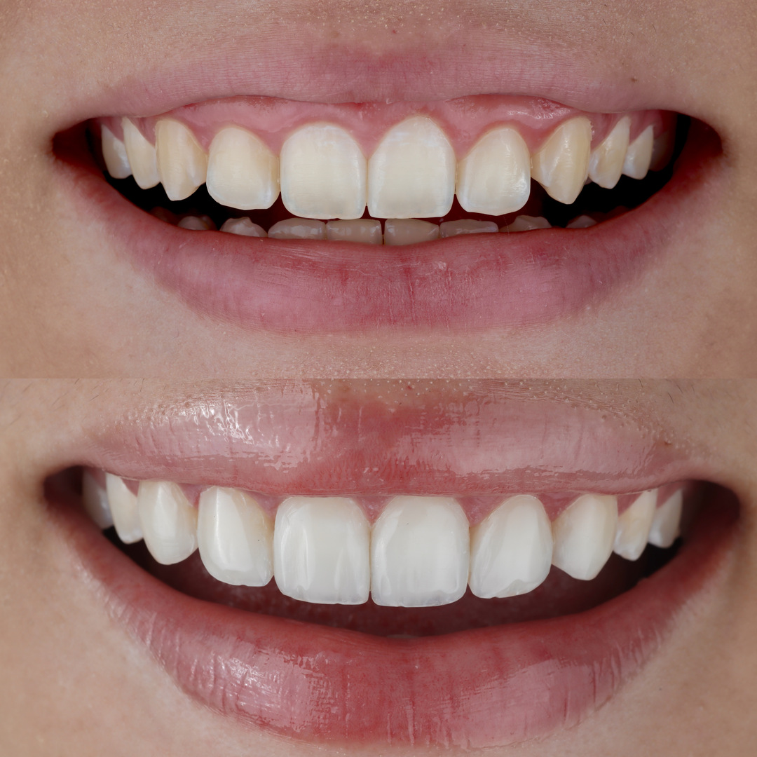 Caso real: antes y después de diseño de sonrisa